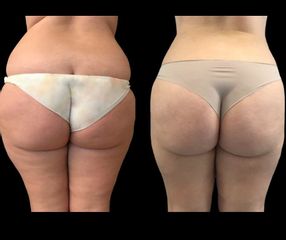 liposuzione fianchi prima e dopo