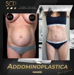 Addominoplastica - SCEB Salute Chirurgia Estetica Benessere - Dott. Manuel De Giovanni