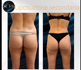 SCEB Salute Chirurgia Estetica Benessere Liposuzione