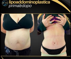 SCEB Salute Chirurgia Estetica Benessere lipoaddominoplastica