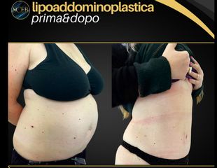 SCEB Salute Chirurgia Estetica Benessere Lipoaddominoplastica
