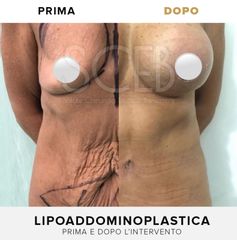 SCEB Salute Chirurgia Estetica Benessere Lipoaddominoplastica