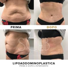 SCEB Salute Chirurgia Estetica Benessere Lipoaddominoplastica