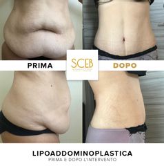 SCEB Salute Chirurgia Estetica Benessere Lipoaddominoplastica