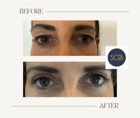 SCEB Salute Chirurgia Estetica Benessere Blefaroplastica