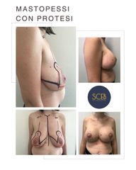 SCEB Salute Chirurgia Estetica Benessere Mastopessi con protesi