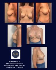 SCEB Salute Chirurgia Estetica Benessere Madtoplastica Riduttiva con protesi anatomiche