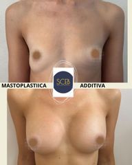 MASTOPLASTIICA - SCEB Salute Chirurgia Estetica Benessere
