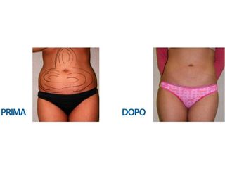 Liposuzione addome prima dopo