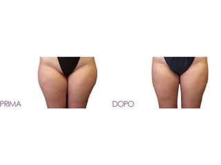 Liposuzione prima e dopo