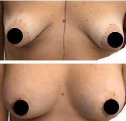 Mastoplastica additiva - Dott. Massimiliano Sparacello - Novamedis Day Surgery