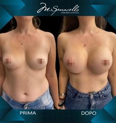 Mastoplastica additiva - Dott. Massimiliano Sparacello - Novamedis Day Surgery