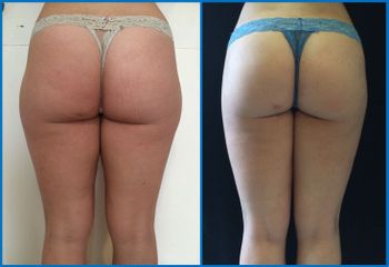 Liposuzione prima e dopo