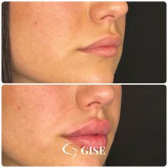 Filler labbra - GISE -Dr. Giorgio Giovannelli