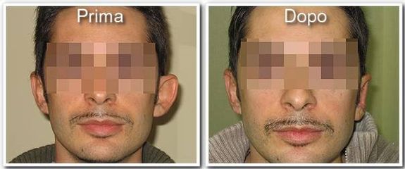 Otoplastica prima e dopo