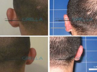 Otoplastica prima e dopo
