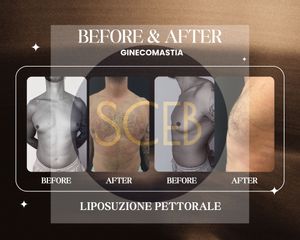 Ginecomastia - Liposuzione Pettorale