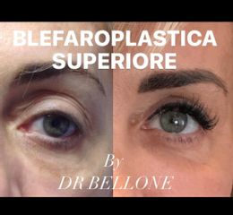 Blefaroplastica - Dott. Bellone Donato