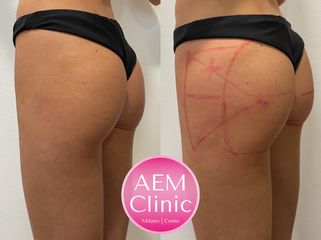 Filler Glutei - Dr. Luca Zattoni