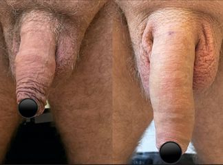 Ingrossamento pene con acido ialuronico - Dr. Luca Zattoni
