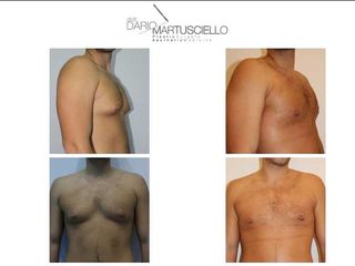 Ginecomastia prima e dopo