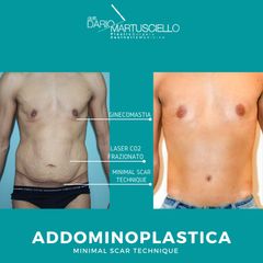 Addominoplastica - Dott. Dario Martusciello - Dama Medical Center