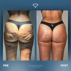 Dott. Dario Martusciello Diamond Incision