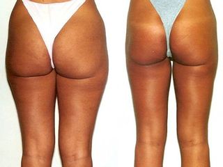 Liposuzione prima e dopo