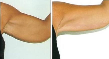 lifting braccia