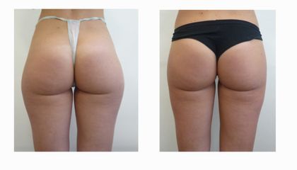Liposcultura