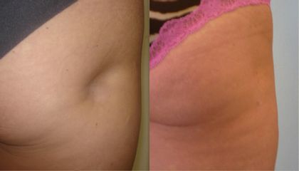 Lipofilling gluteo