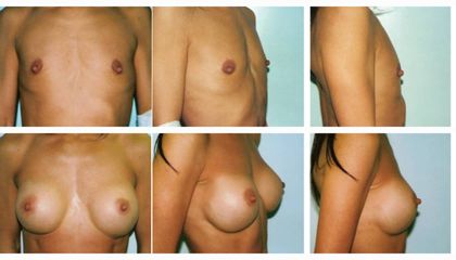 mastoplasticaaditiva