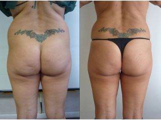 Liposuzione - Dott. Stefano Bezzi