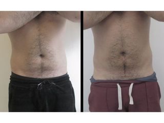 Liposuzione - Dott. Stefano Bezzi