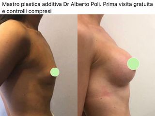 Mastoplastica additiva - Dott. Alberto Poli Cliniche Nova Genesis
