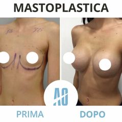 Mastoplastica additiva - Dott. Orlandi Alberto
