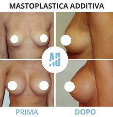 Mastoplastica additiva - Dott. Orlandi Alberto