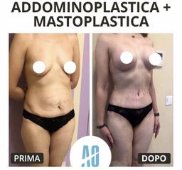 Addominoplastica - Dott. Orlandi Alberto