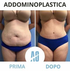 Addominoplastica - Dott. Orlandi Alberto