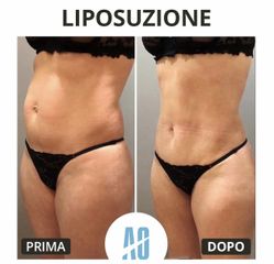Liposuzione - Dott. Orlandi Alberto