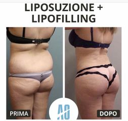 Liposuzione - Dott. Orlandi Alberto