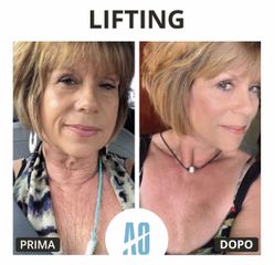 Lifting viso - Dott. Orlandi Alberto