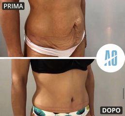 Addominoplastica - Dott. Orlandi Alberto