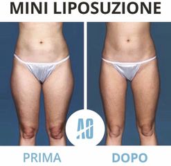 Liposuzione - Dott. Orlandi Alberto