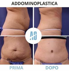 Addominoplastica - Dott. Orlandi Alberto
