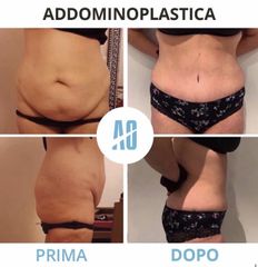 Addominoplastica - Dott. Orlandi Alberto