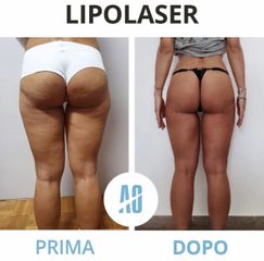Liposuzione - Dott. Orlandi Alberto