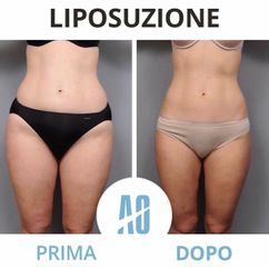 Liposuzione - Dott. Orlandi Alberto