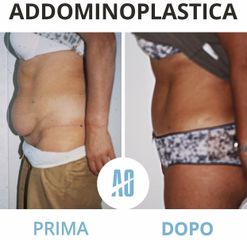 Addominoplastica - Dott. Orlandi Alberto