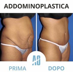 Addominoplastica - Dott. Orlandi Alberto